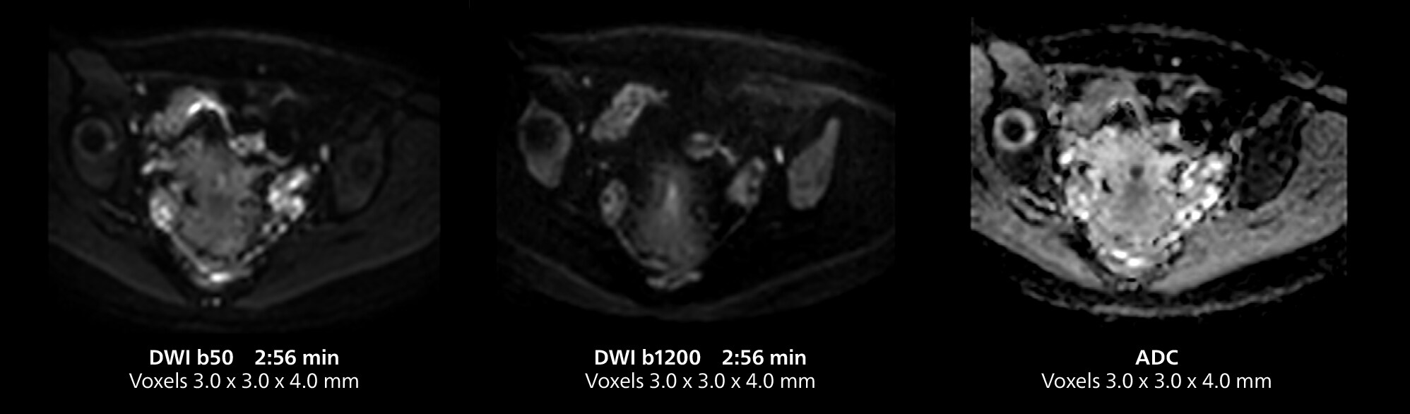 Pelvis mri three