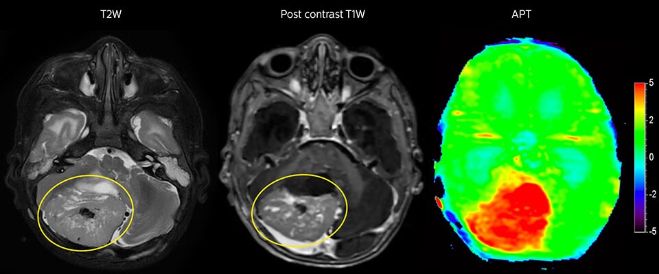 APT imaging of high-grade tumor