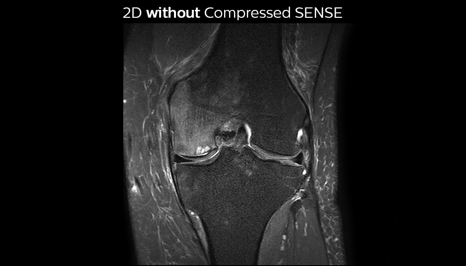 PD FS SPAIR knee without Compressed SENSE cor