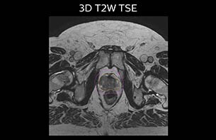 Turku MRI-T2W therapy case 2