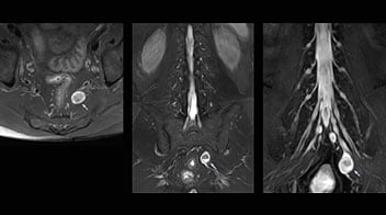 Peripheral nerve sheath tumor (schwannoma)