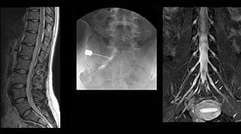 Left sacroiliac arthritis