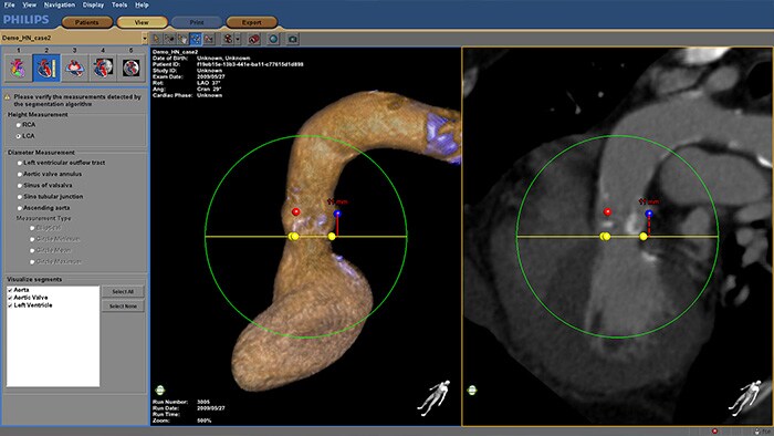 HeartNavigator procedure