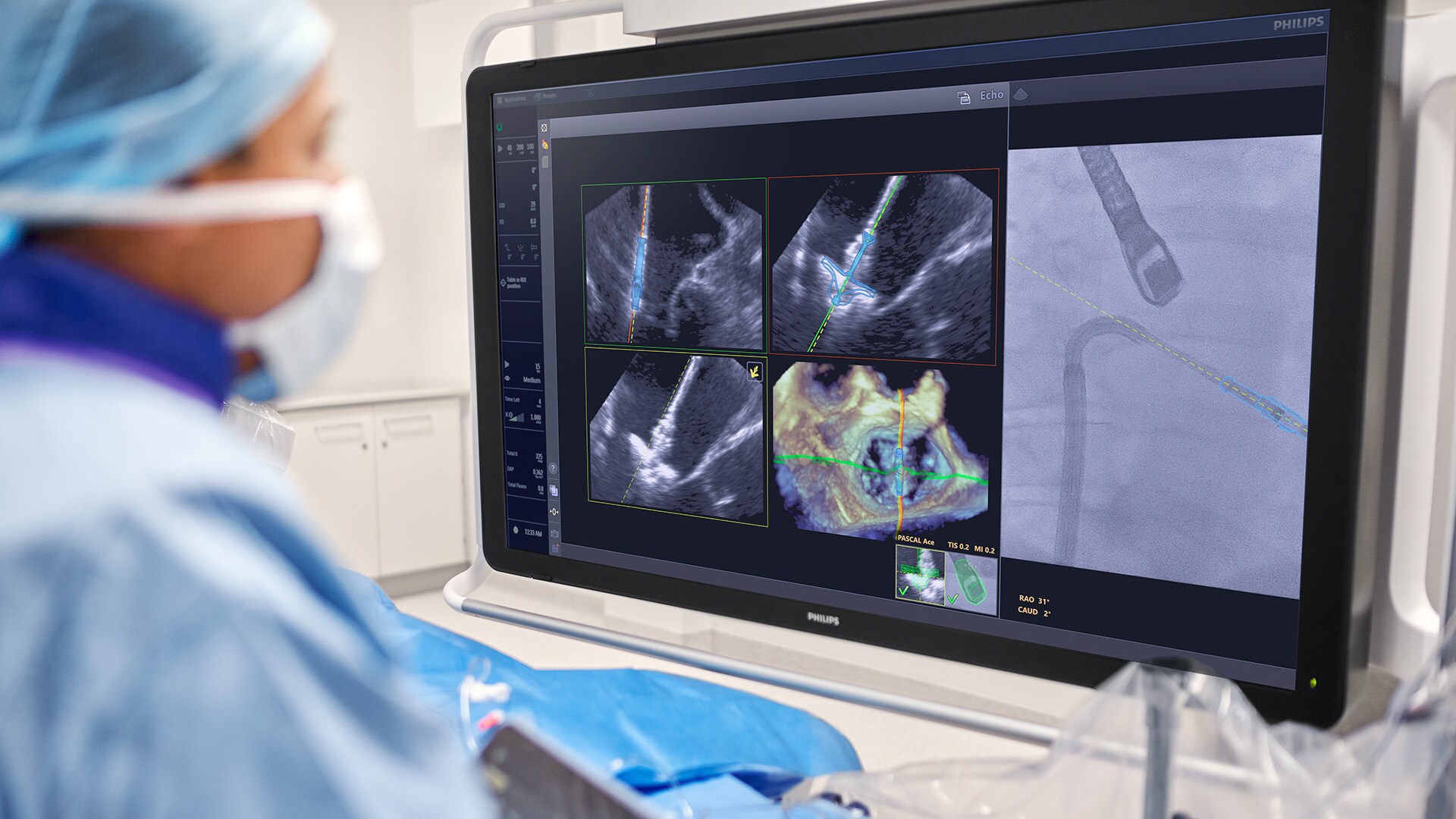 Philips brings AI into the procedure room to assist doctors during heart valve repair